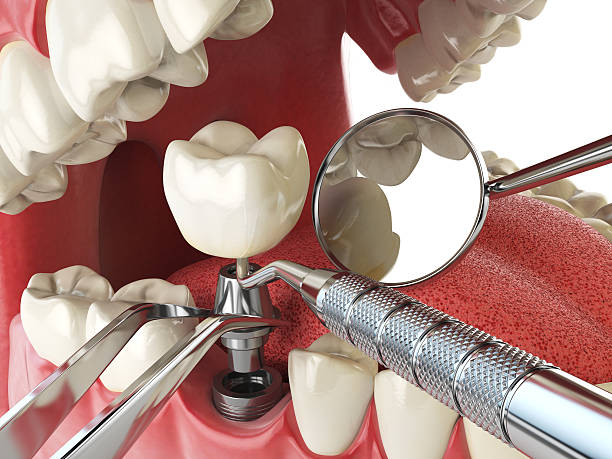 Best Emergency Tooth Extraction in Long View, NC